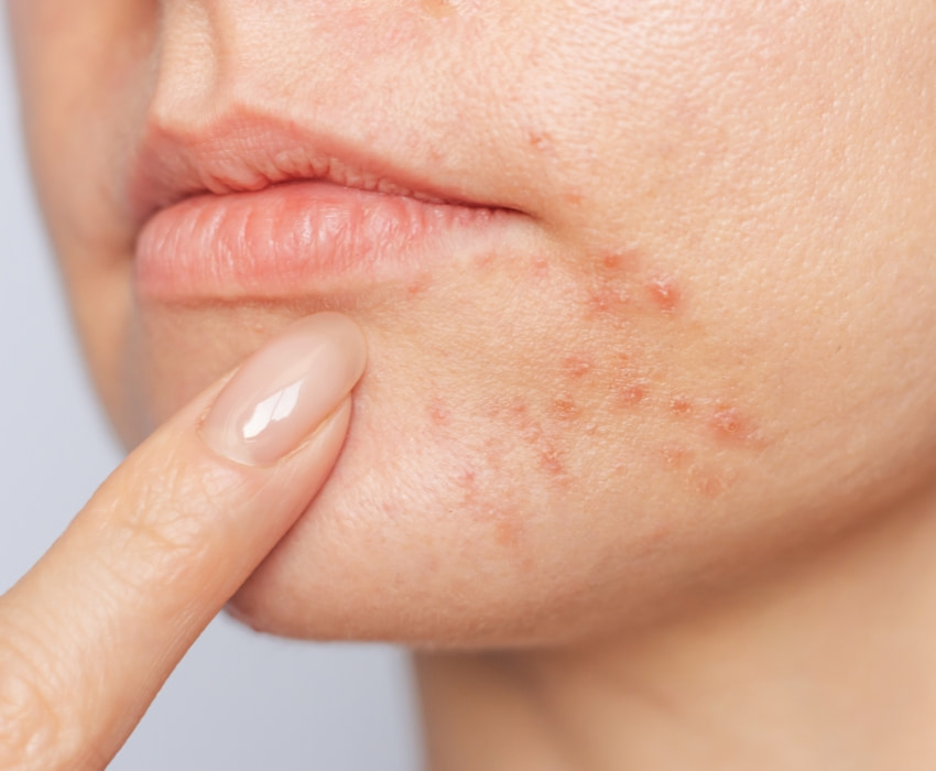 Periorale Dermatitis Behandlung