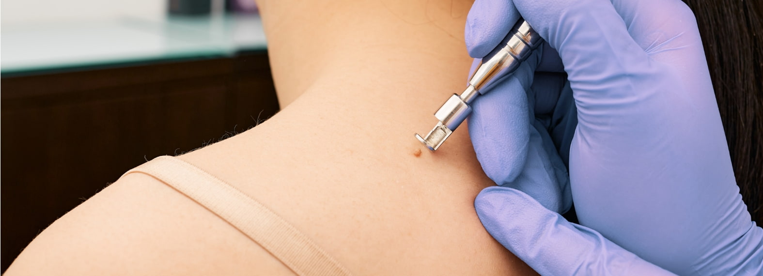 Behandlung von Fibromen