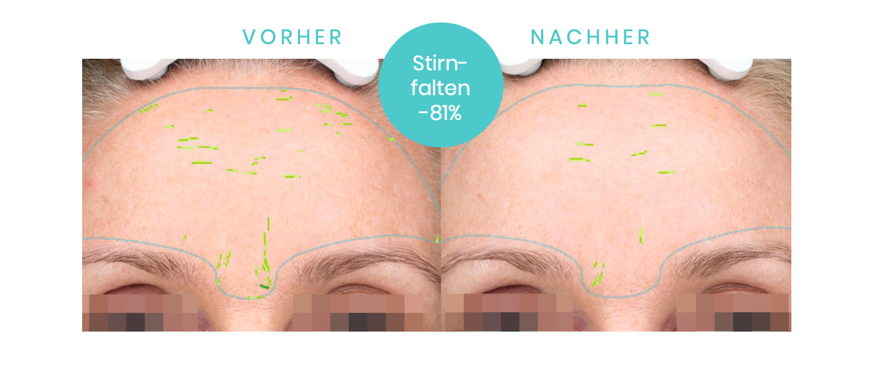 SUNEKOS Behandlung in Zürich