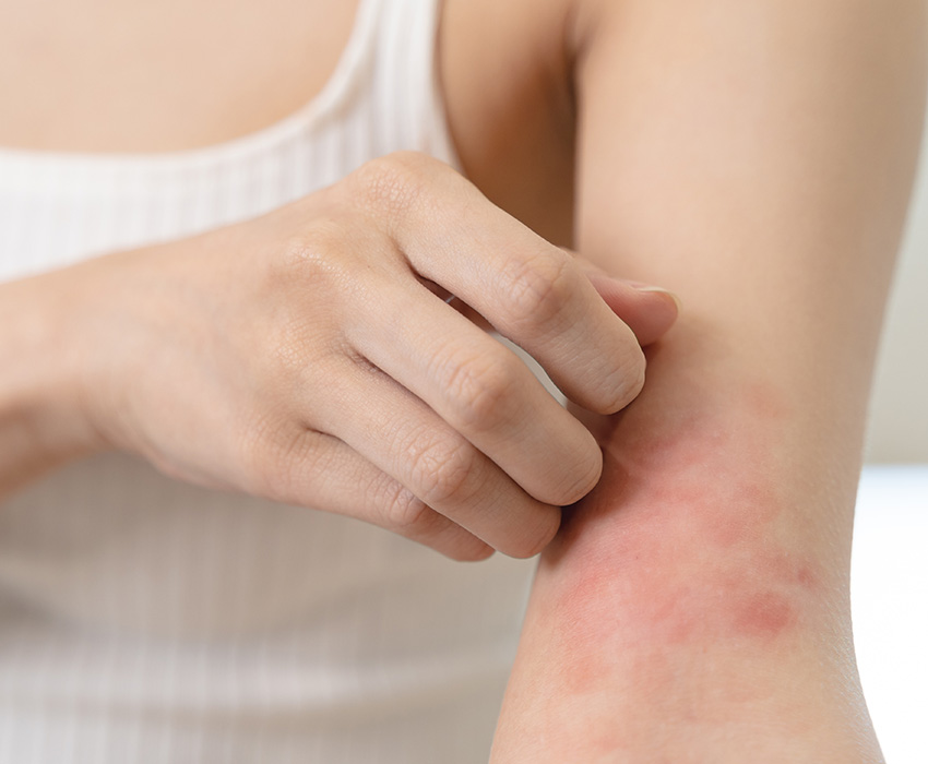 Allergietest in Zürich