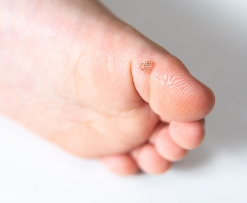 Warzen bei Kindern behandeln
