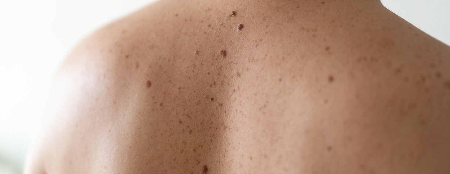 schwarzer-hautkrebs-behandeln-in-zuerich-faq