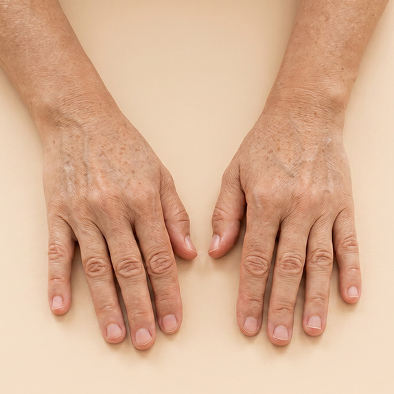 Handverjüngung