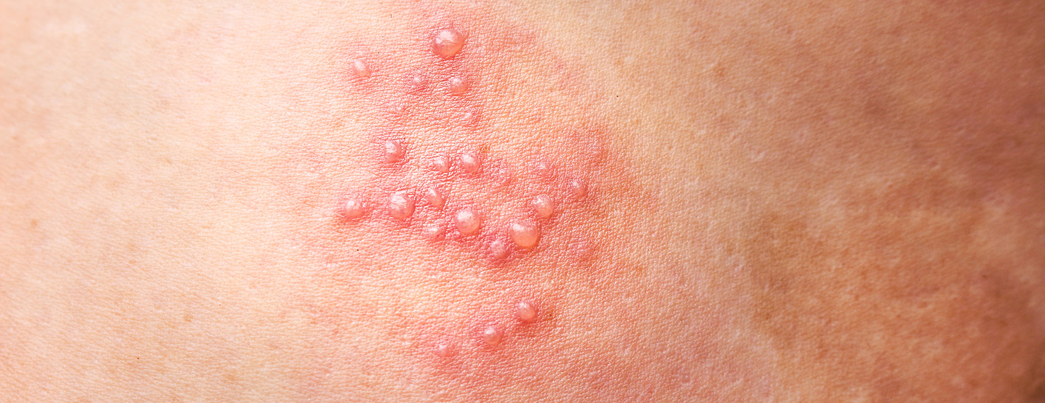 Cold sores and genital blisters – FAQ