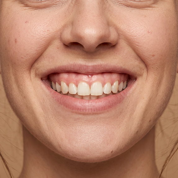 Gummy-Smile-Behandlung