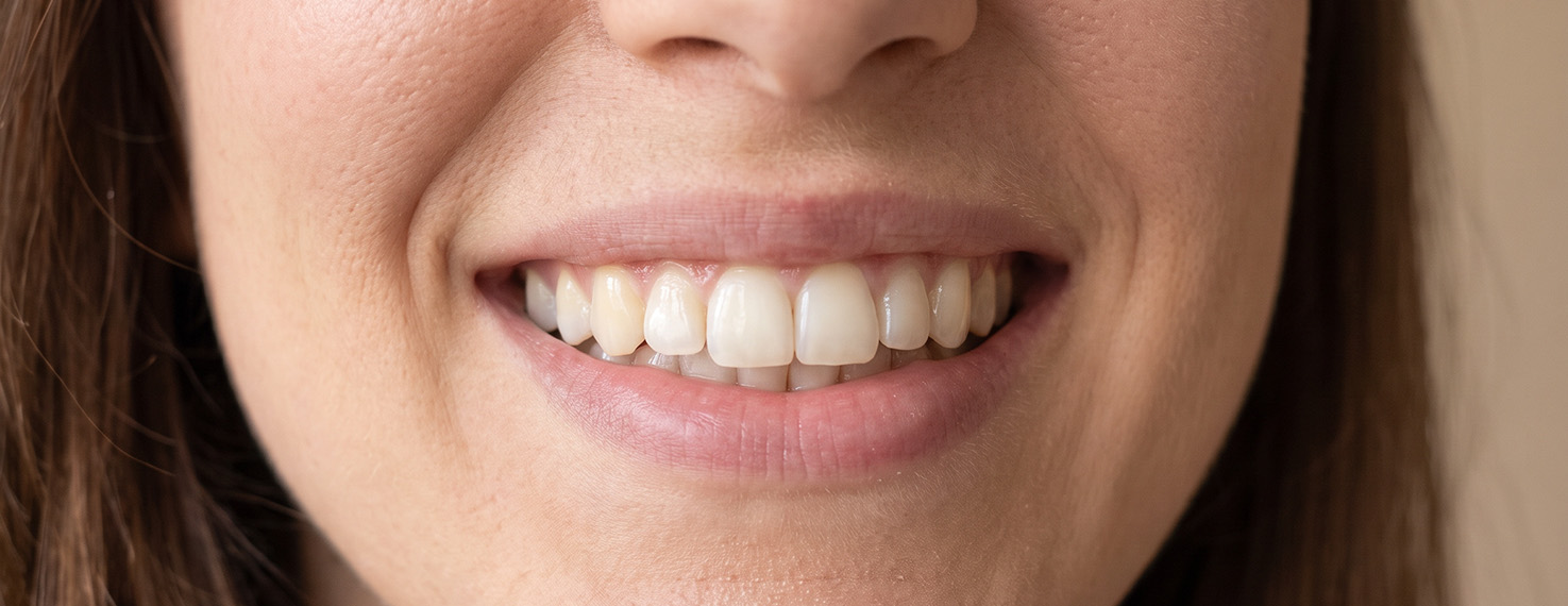 Gummy-Smile-Behandlung in Zürich